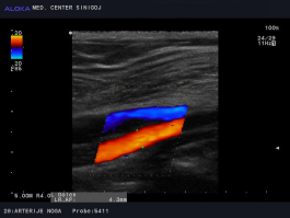 Ultrazvok žil nog - stenska tromboza vene v kolenu (v. poplitea)